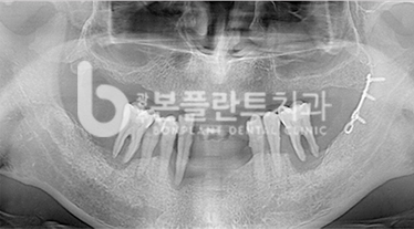 고난이도 임플란트 - 치료 전