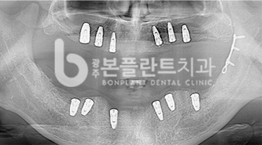 고난이도 임플란트 - 치료 중