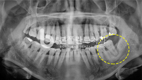 고난이도 임플란트 - 시술 전