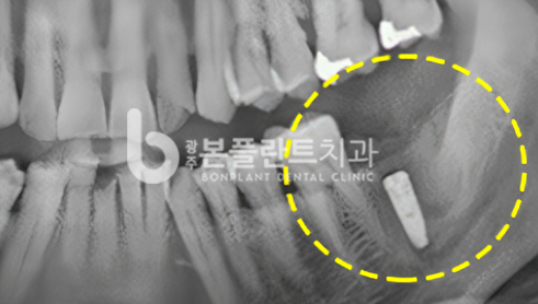 고난이도 임플란트 - 시술 후