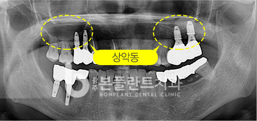 고난이도 임플란트 - 치료 전 2