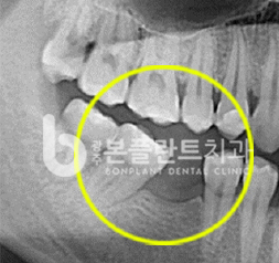 고난이도 임플란트 - 시술 전 3