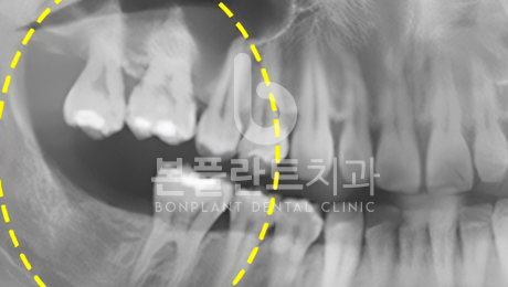 고난이도 임플란트 - 치료 전 4