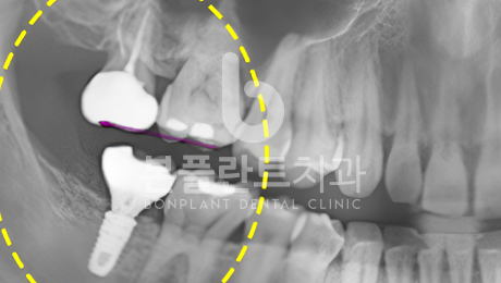 고난이도 임플란트 - 치료 후 5