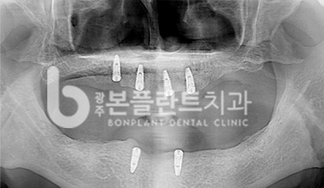 고난이도 임플란트 - 임플란트 틀니는 훨씬 더 안정적이고 튼튼합니다.