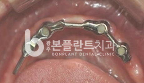 고난이도 임플란트 - 틀니 종류 +