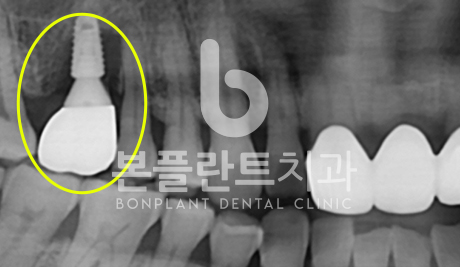 고난이도 임플란트 - 시술 전 4