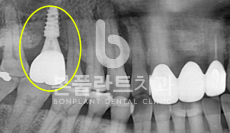 고난이도 임플란트 - 시술 후 4
