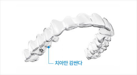 인비절라인 치아교정 - 인비절라인 VS 일반 투명교정