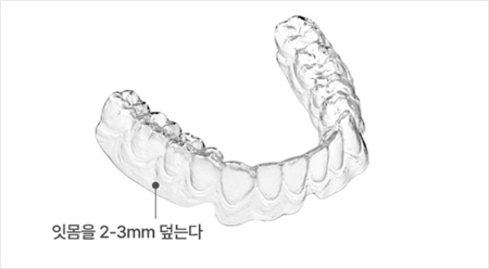 인비절라인 치아교정 - 인비절라인 치아교정
