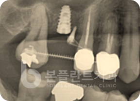 중장년층 치아교정 - 중장년층 치아교정 2
