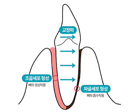 중장년층 치아교정 - 중년 교정, 성장기 교정과는 다른 접근 이 필요합니다