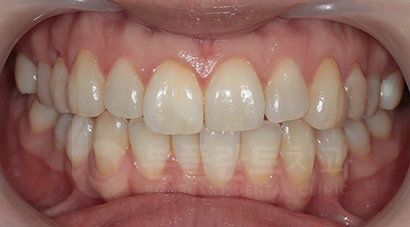 치아 재교정 - 치료 전