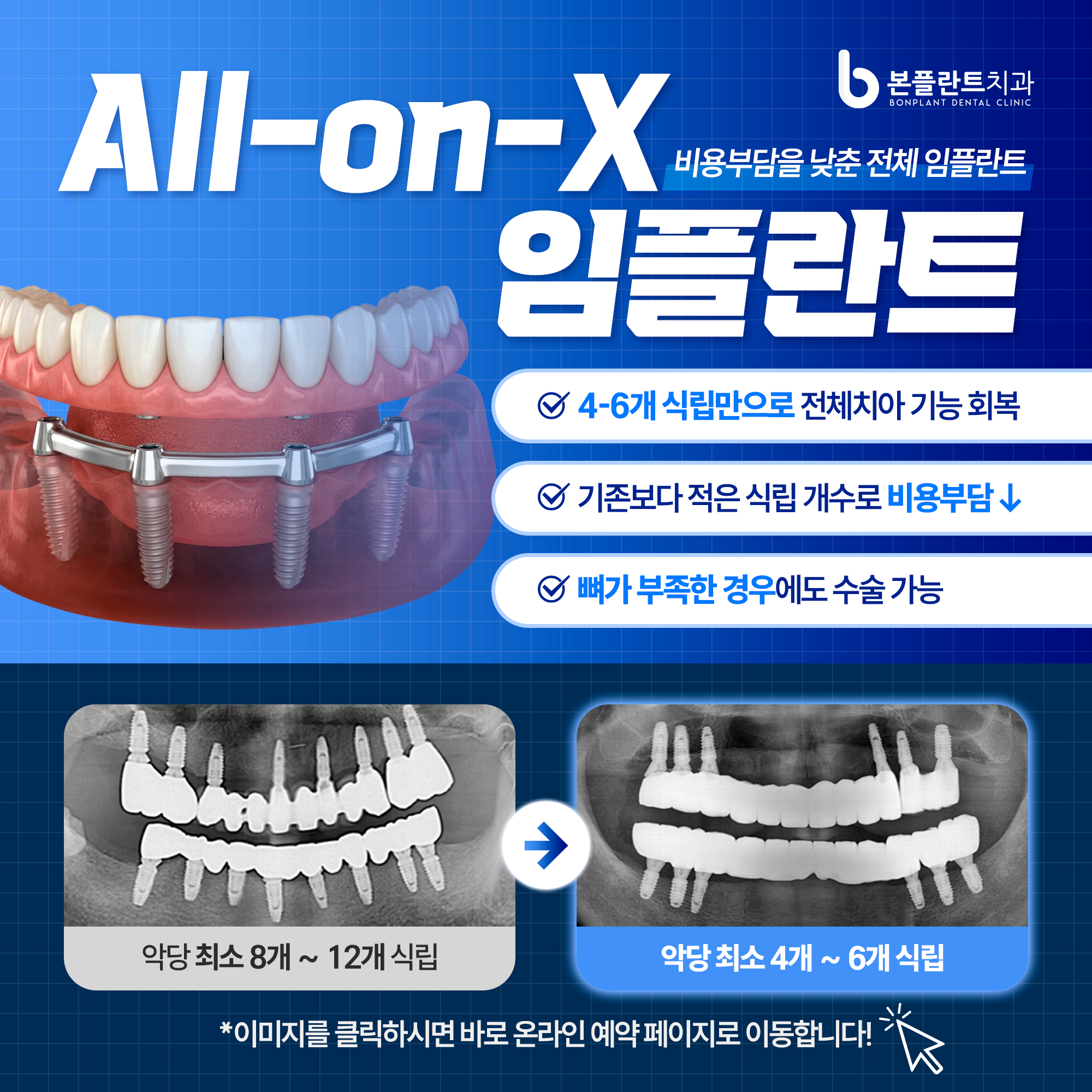 All-on-X 임플란트