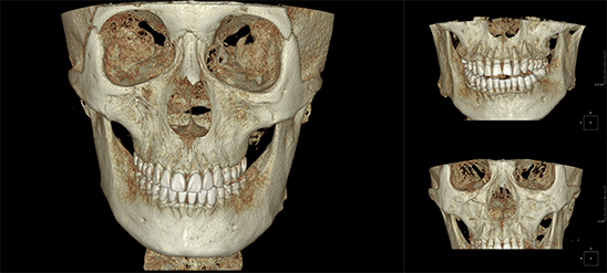 디지털 시스템 - 정확성 높고 객관적인 디지털 진단 3D CT, 디지털 분석 프로그램 활용